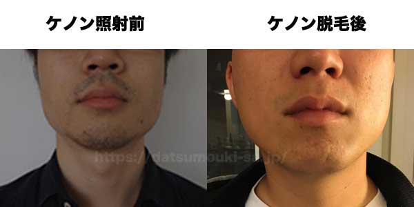 ヒゲ脱毛のビフォーアフター