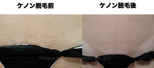 Vラインのビフォーアフター